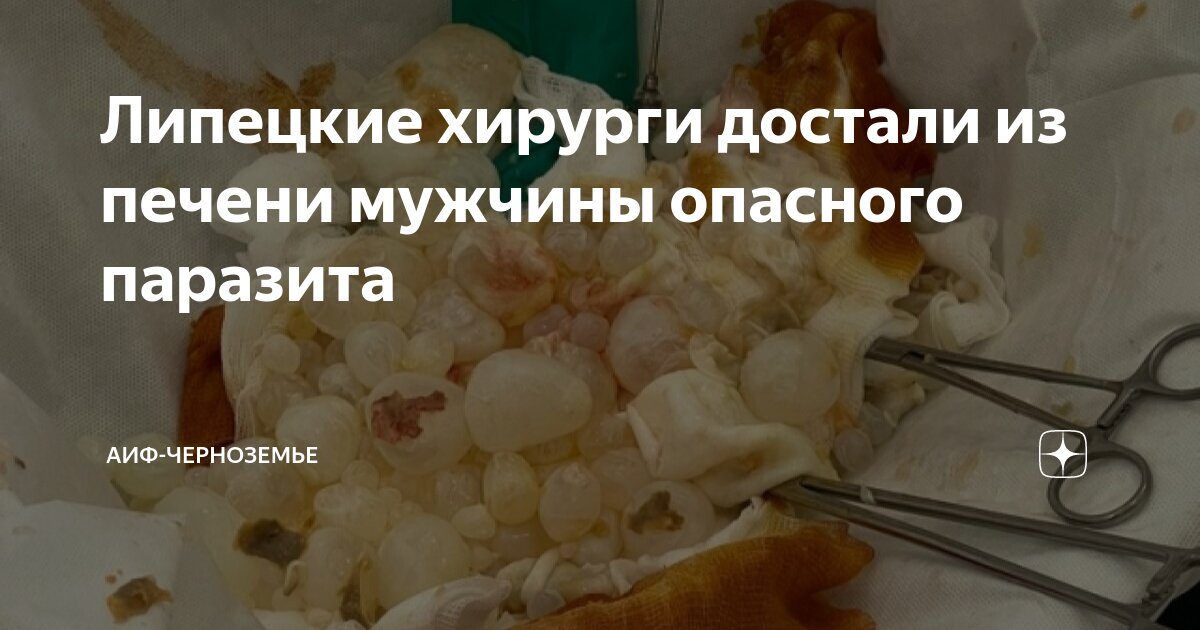 Липецкие хирурги достали из печени мужчины опасного паразита | АиФ ...