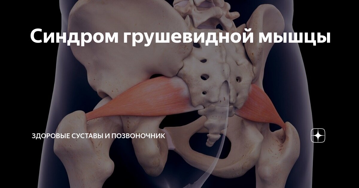 Синдром грушевидной мышцы | Здоровые суставы и позвоночник | Дзен