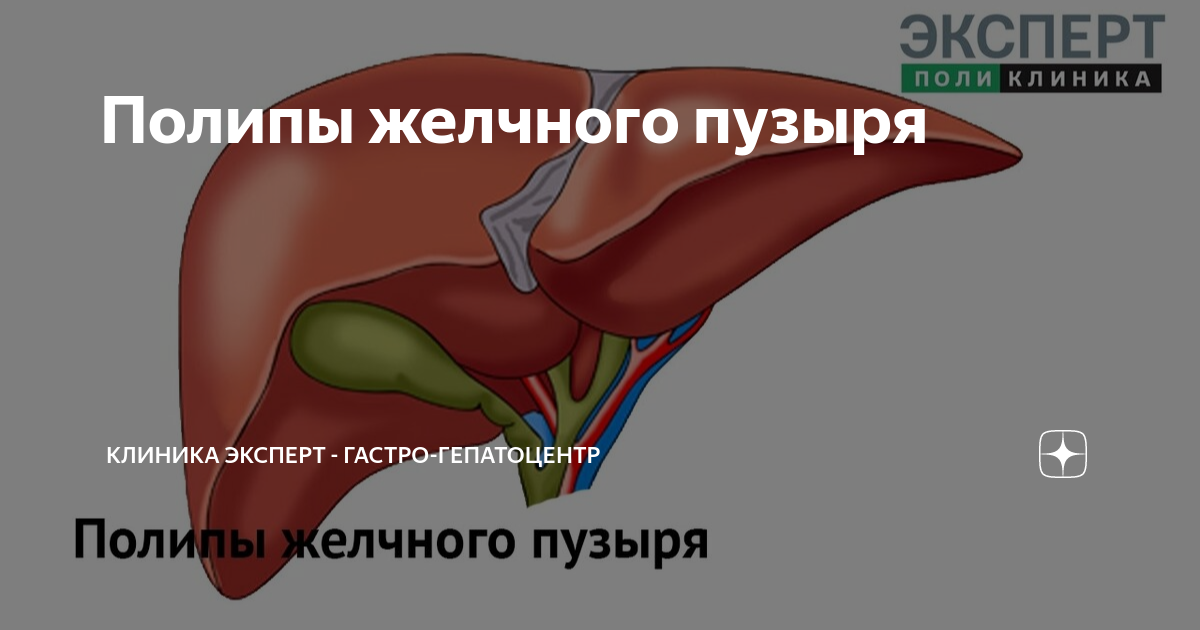 полип в желчном пузыре диета
