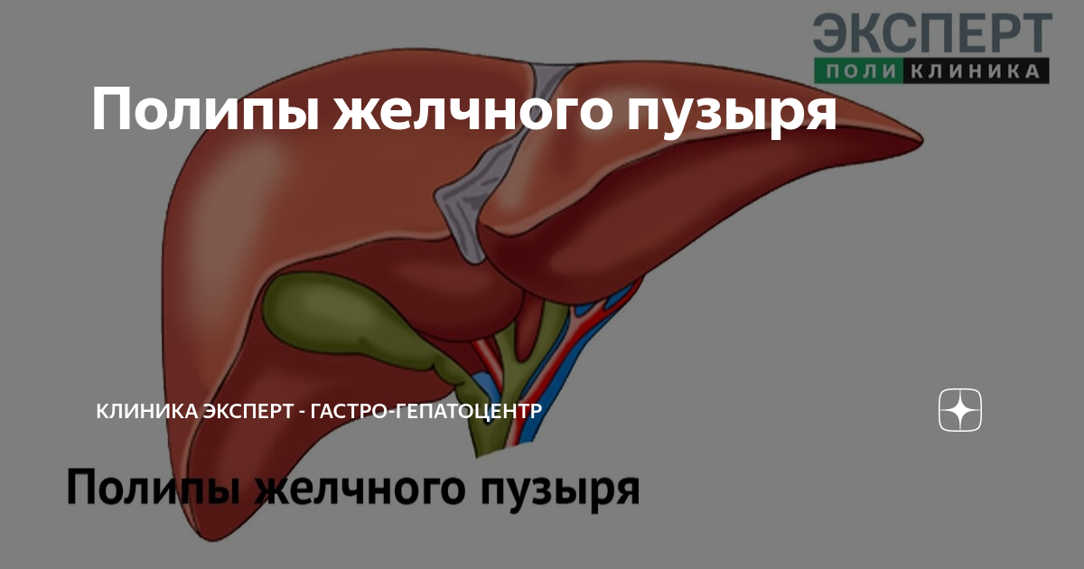 Полип в желчном пузыре: симптомы и лечение