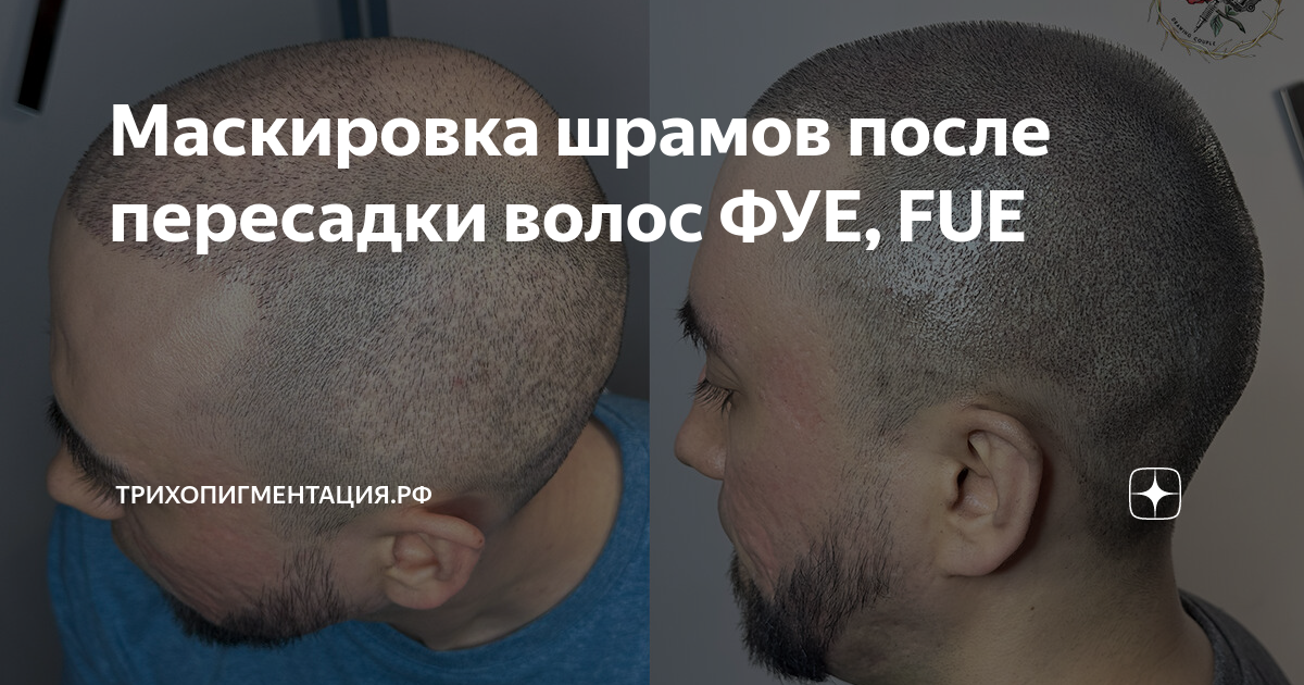 Маскировка шрамов после пересадки волос ФУЕ, FUE | Трихопигментация.рф ...