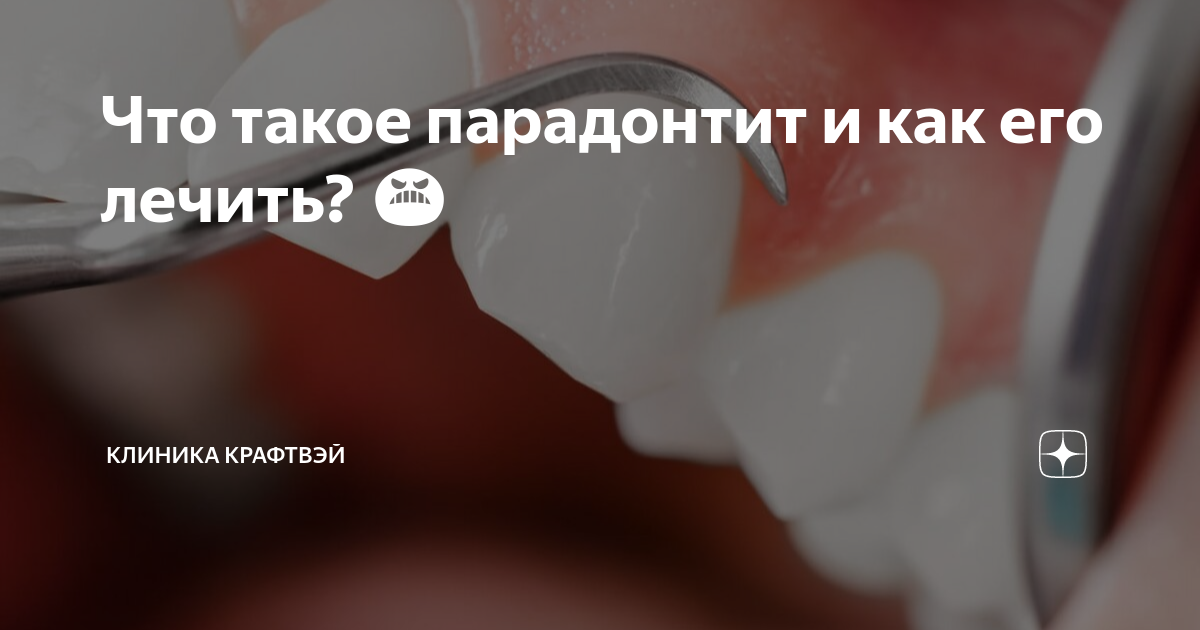 парадонтоз и парадонтит лечение