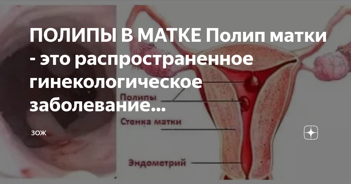 Полипы матки — симптомы, диагностика и лечение заболевания в Hadassah