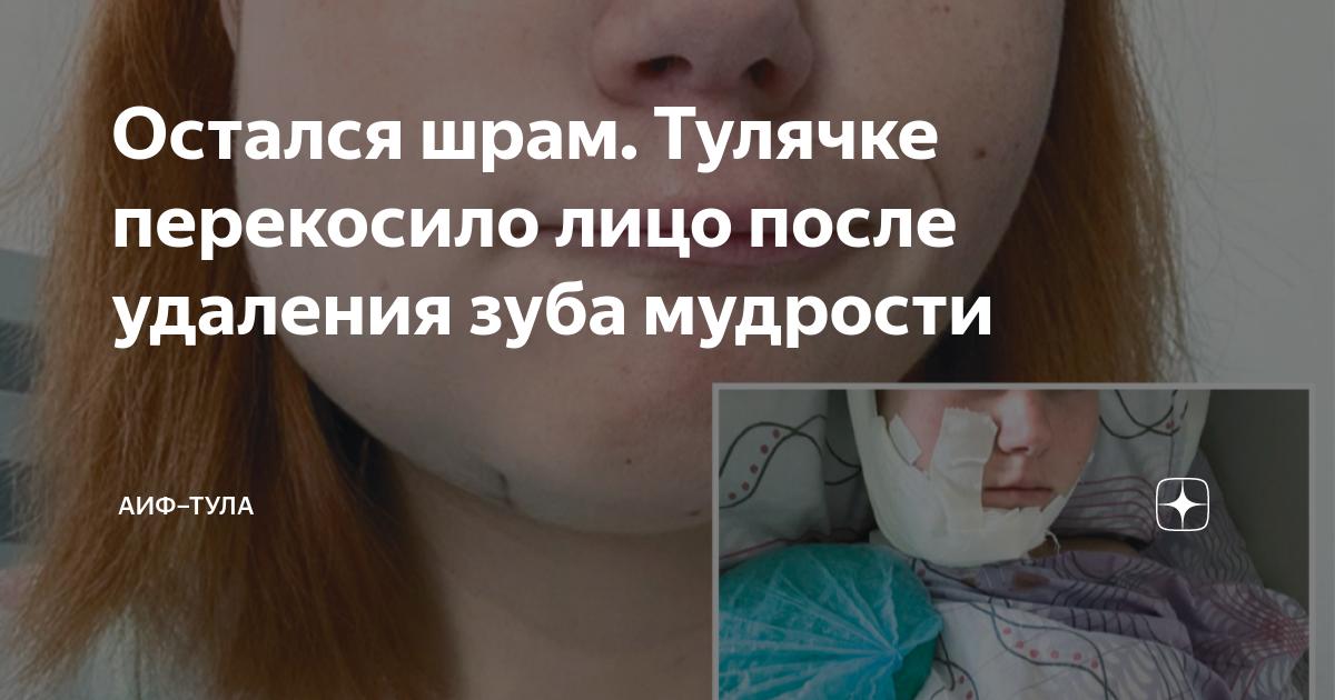 сколько дней опухает лицо после удаления зуба мудрости