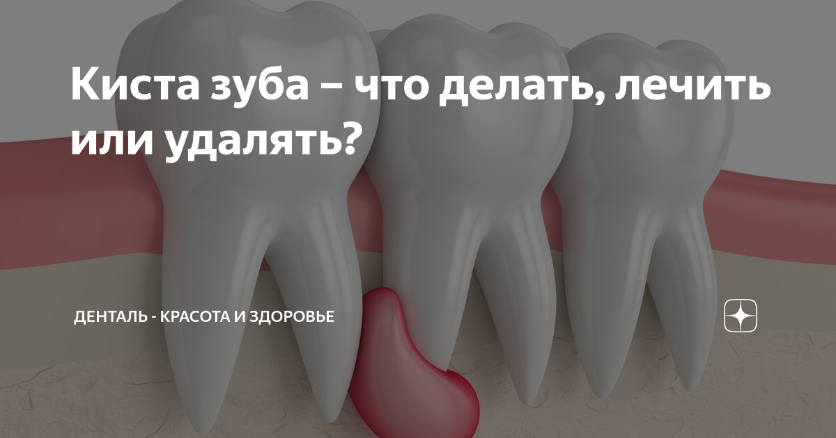 Киста зуба: что это и как лечить