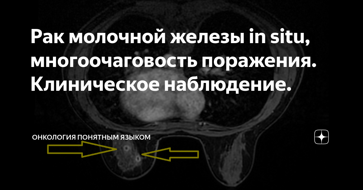 Рак молочной железы in situ, многоочаговость поражения. Клиническое ...