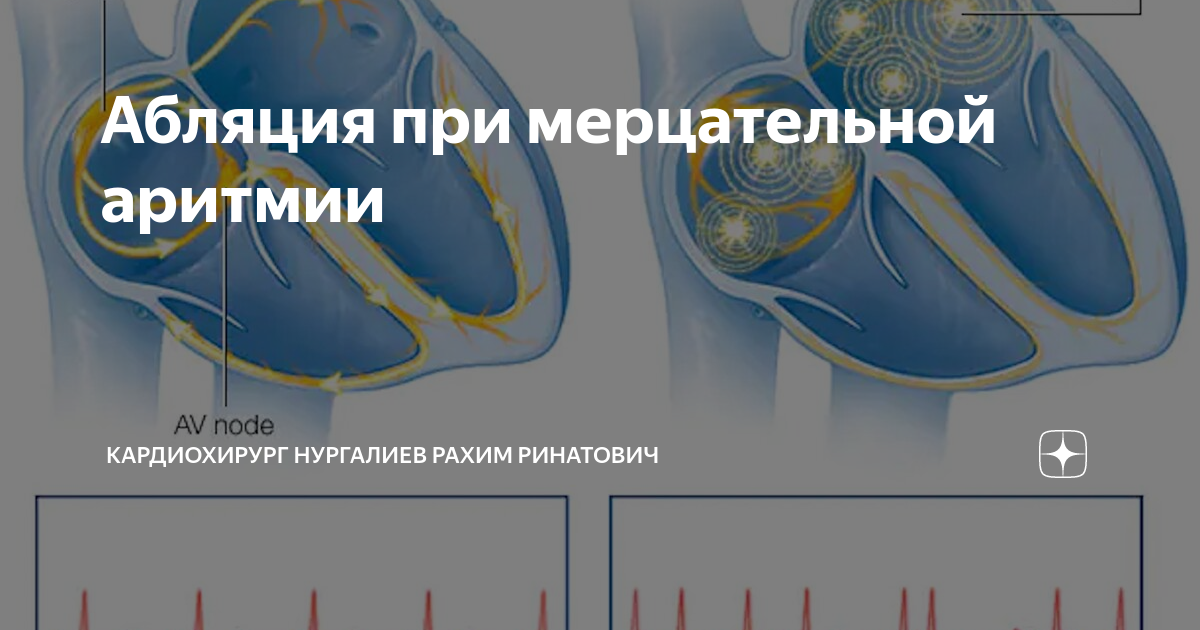 Абляция при мерцательной аритмии | Кардиохирург Нургалиев Рахим ...