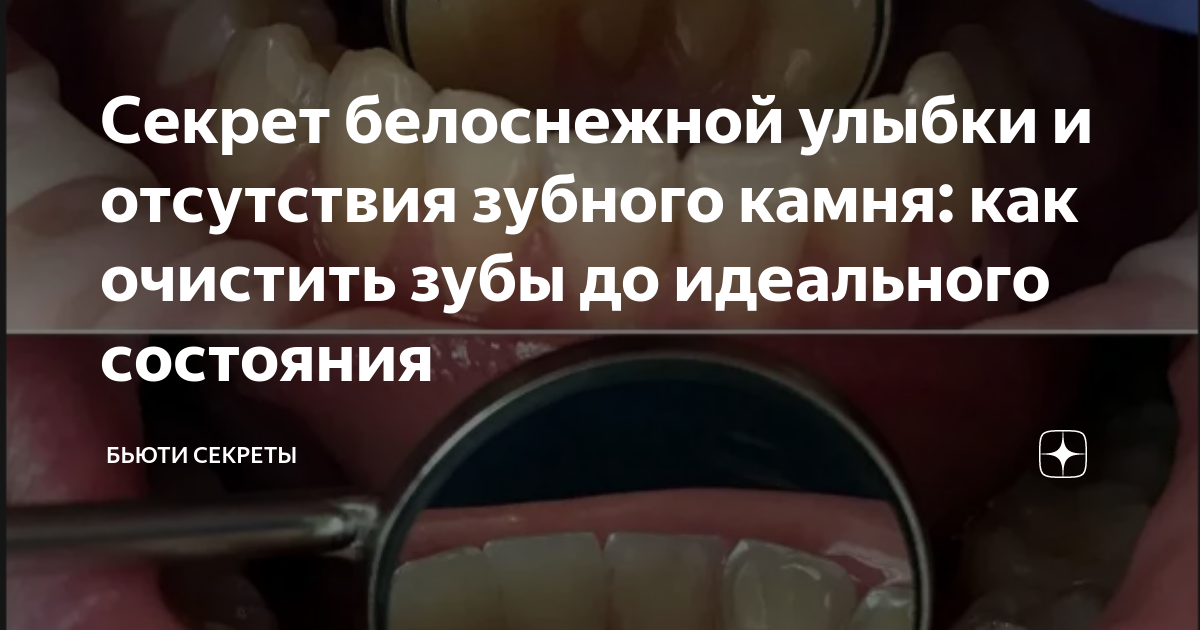 Секрет белоснежной улыбки и отсутствия зубного камня: как очистить зубы ...