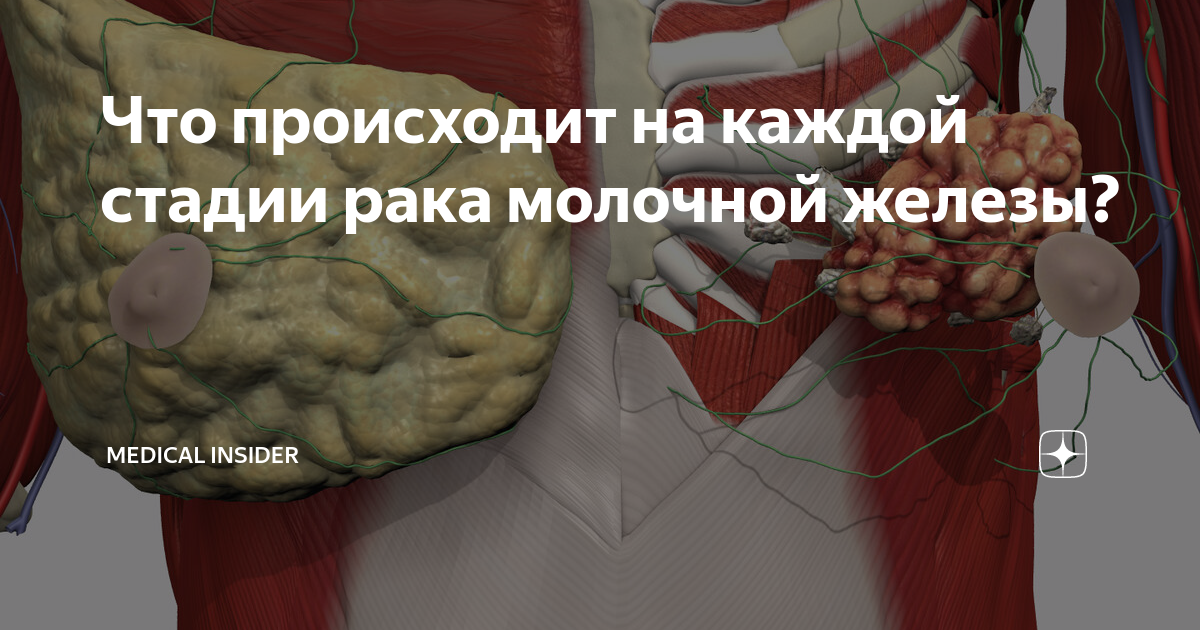 Что происходит на каждой стадии рака молочной железы? | Мedical Insider ...
