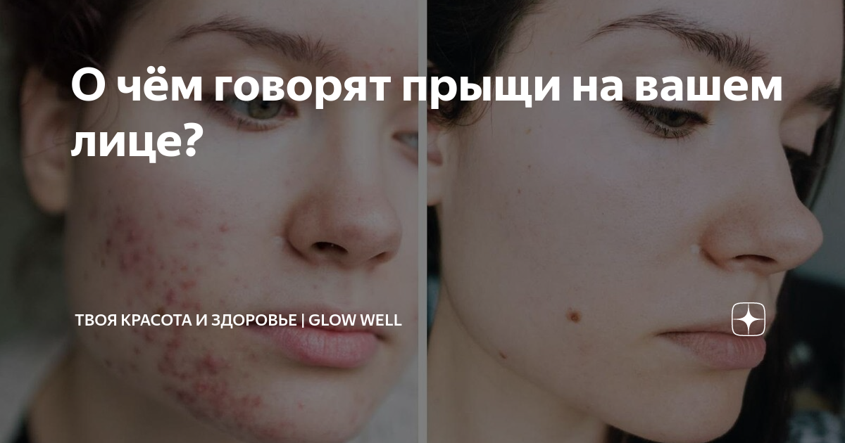 О чём говорят прыщи на вашем лице? | Твоя красота и здоровье | Glow Well |  Дзен