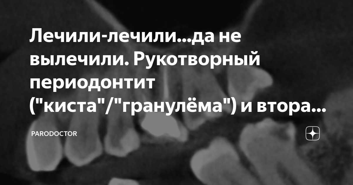 Лечили-лечили...да не вылечили. Рукотворный периодонтит ("киста ...