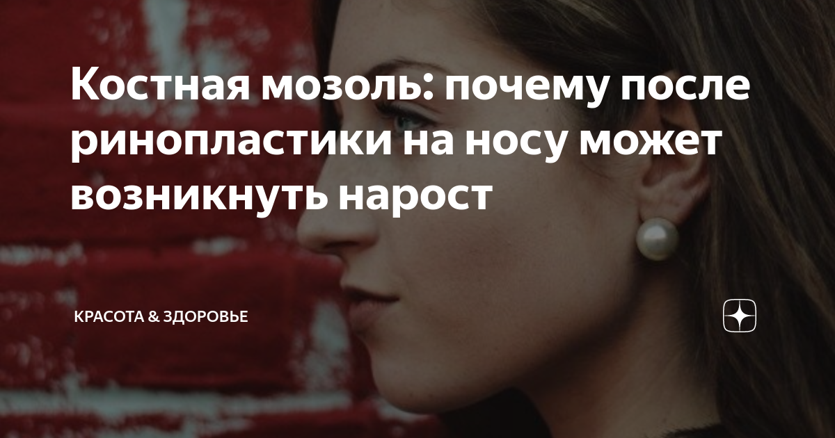Как выглядит костная мозоль после ринопластики Костная мозоль после ринопластики: что это и как она может возникнуть Современны