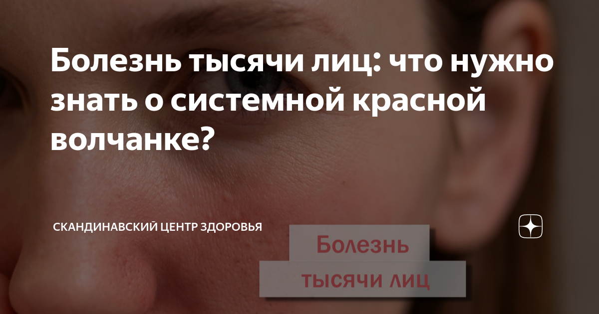 Болезнь тысячи лиц: что нужно знать о системной красной волчанке ...