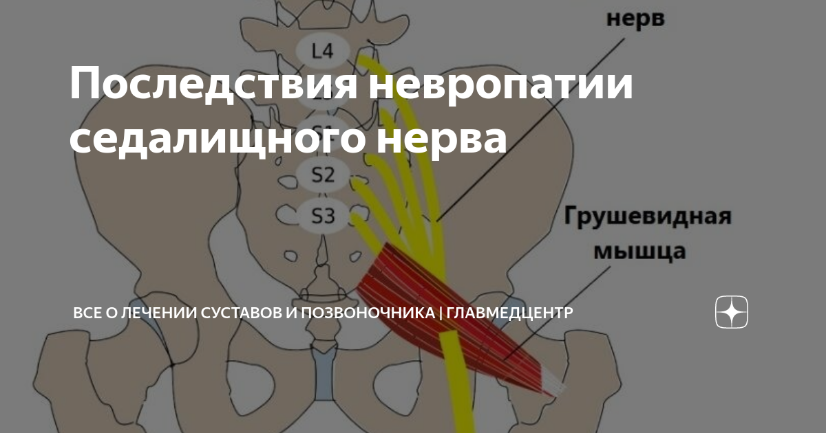 Последствия невропатии седалищного нерва | Многопрофильная клиника в ...