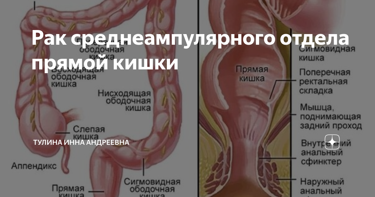 Рак сигмовидной кишки прогноз после операции отзывы. Рак сигмовидной кишки прогноз после операции отзывы