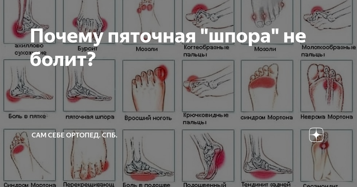 Почему пяточная "шпора" не болит? | Сам Себе Ортопед. Спб. | Дзен