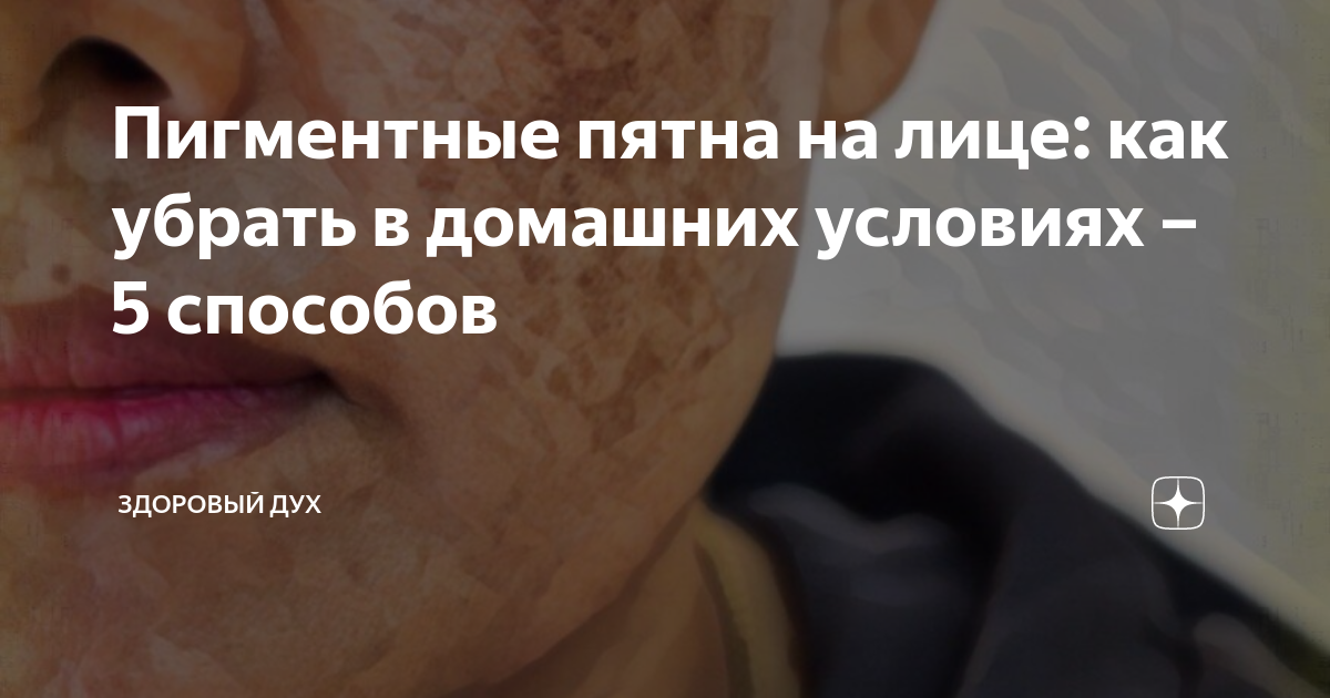 Пигментные пятна на лице: как убрать в домашних условиях – 5 способов ...
