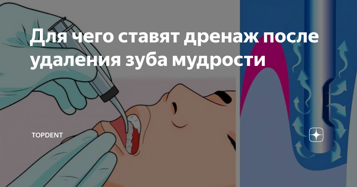 Дренаж в десне: как выглядит (фото) и что делать если выпал | Dental Art