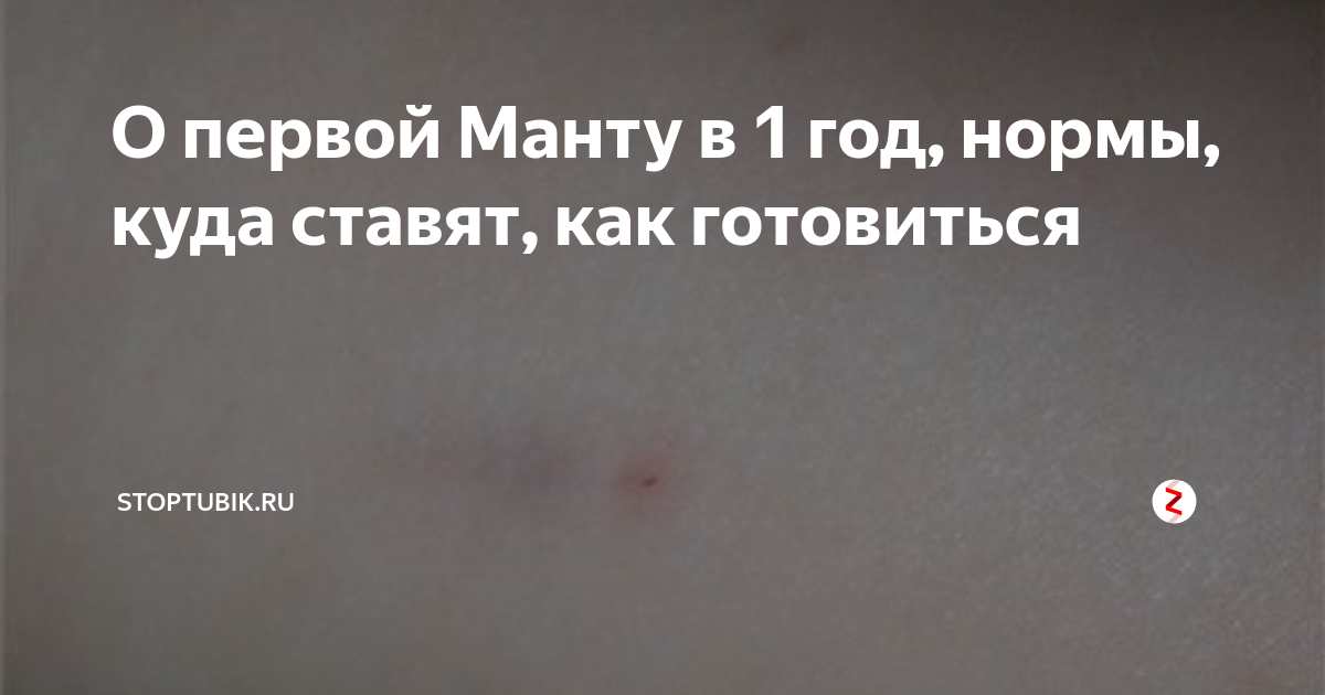 Как выглядит манту в 1 год Как защитить ребенка от туберкулеза и гепатита