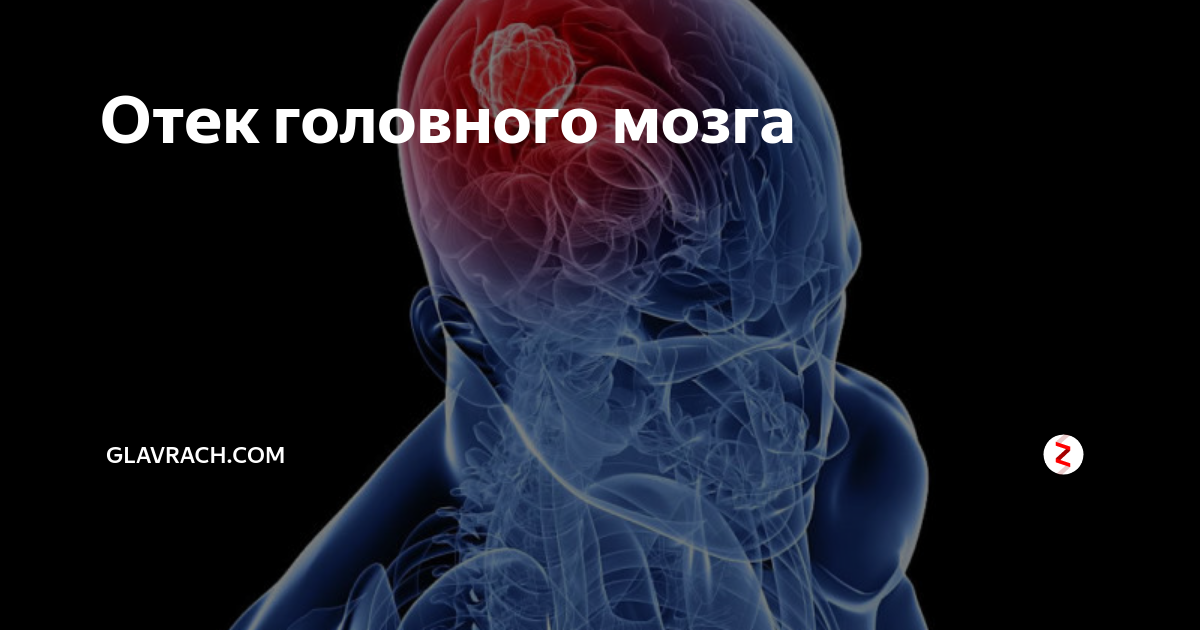 Отек головного мозга. Отек набухание головного мозга. Отёк и набухание головного мозга. Отек вещества головного мозга и оболочек