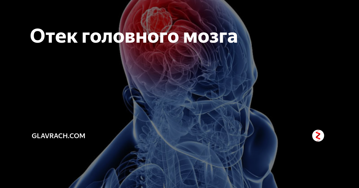 Отек мозга. Отек набухание головного мозга. Отёк и набухание головного мозга. Отек вещества головного мозга и оболочек.