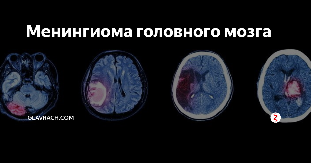 Менингиома головного мозга операция отзывы. Дуральный хвост менингиомы. Менингиома головного мозга. Менингиома серпа мозга.