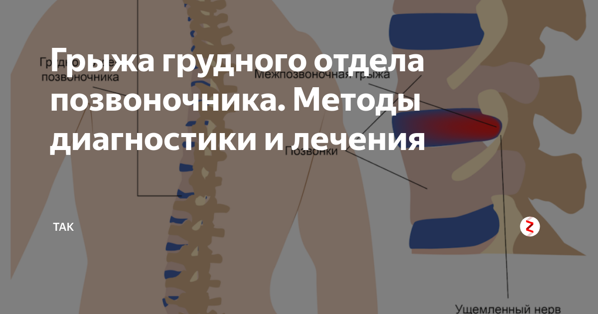 Схема лечения при грыже позвоночника поясничного отдела