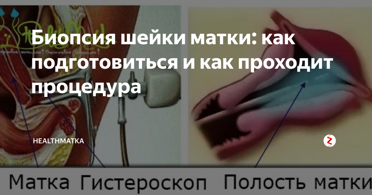 Сколько лежать после биопсии
