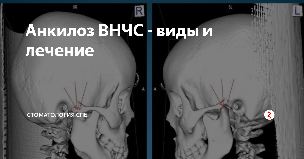 Анкилоз височно-нижнечелюстного сустава: диагностика и лечение