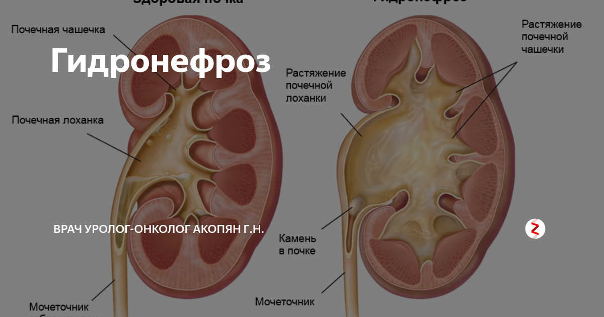 Двусторонний гидронефроз