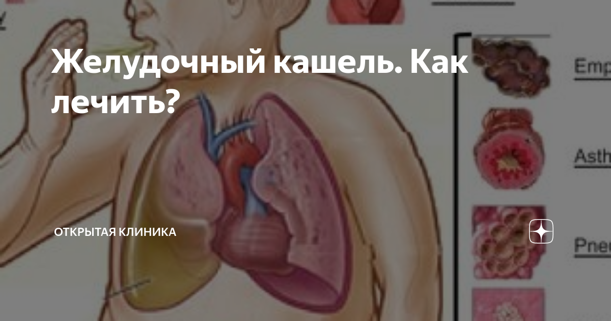 Кашель: симптомы, причины, виды, осложнения и методы лечения в «СМ-Клиника»