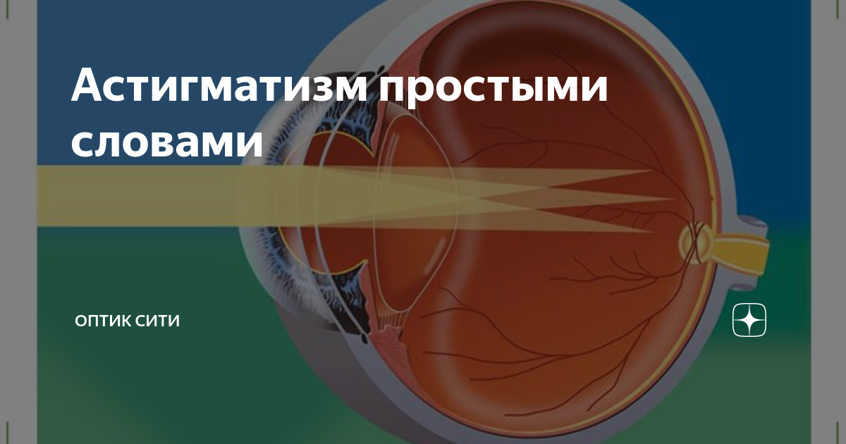 Астигматизм простыми словами | Оптик Сити | Дзен