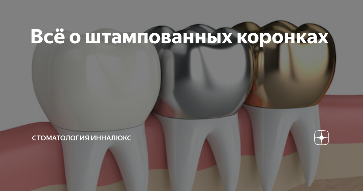Всё о штампованных коронках | Стоматология ИннаЛЮКС | Дзен