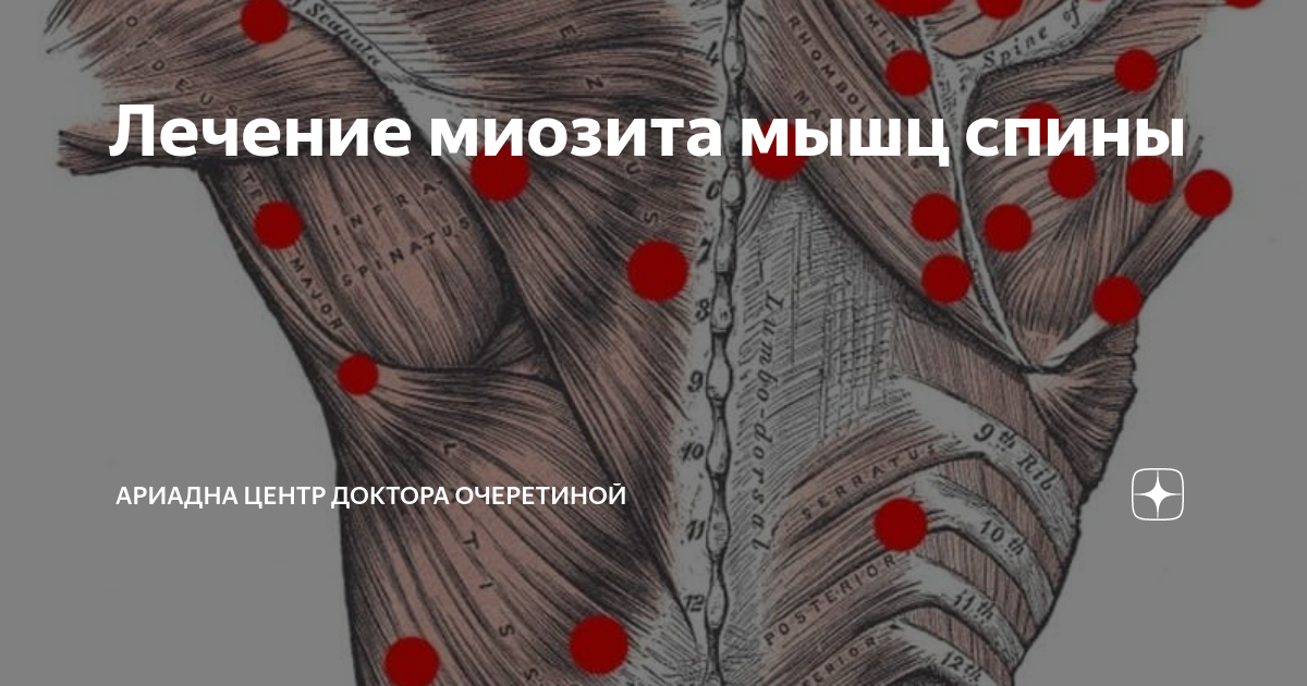 Миозит мышц код. Миозит мышц код