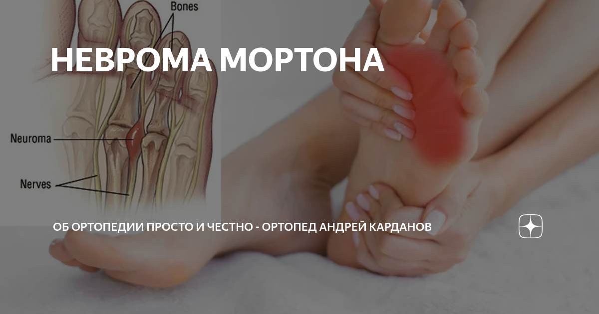 НЕВРОМА МОРТОНА | О СУСТАВАХ ПРОСТО И ЧЕСТНО - ортопед Андрей Карданов ...