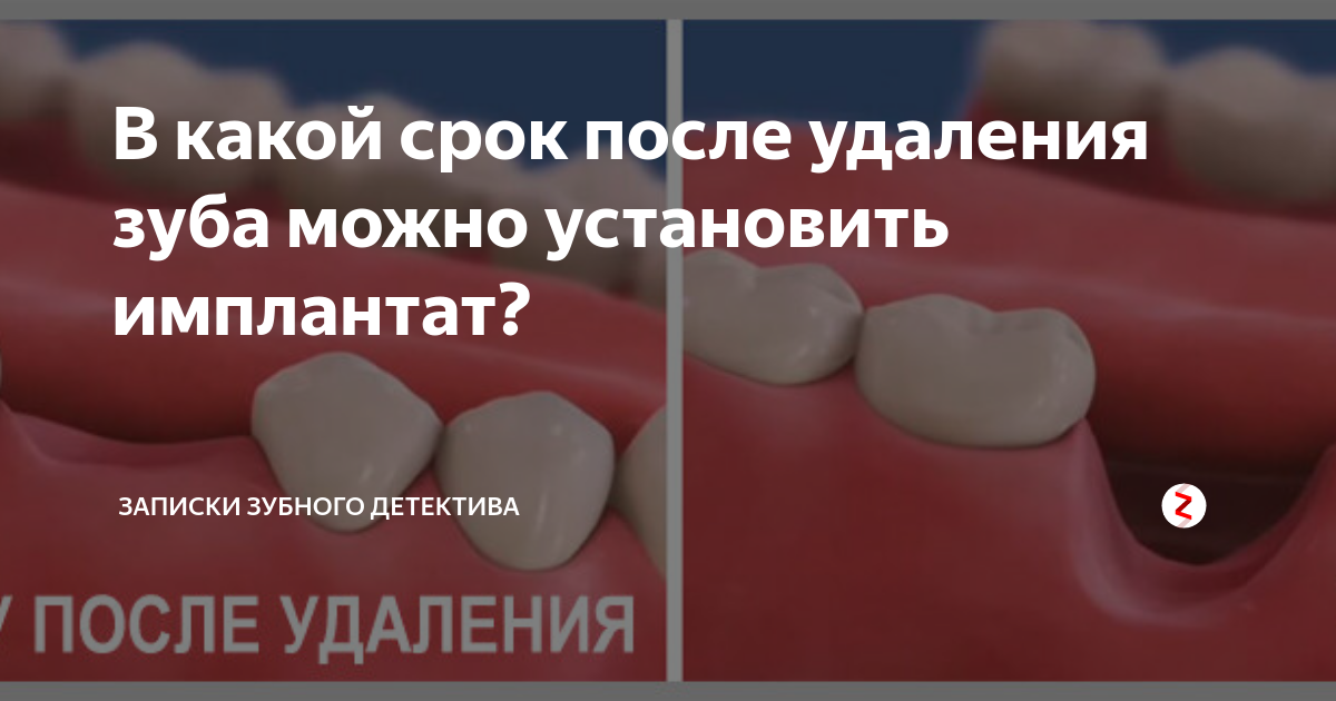 Боль после лечения 6ки и удаления зуба мудрости - Вопрос стоматологу - 03 Онлайн