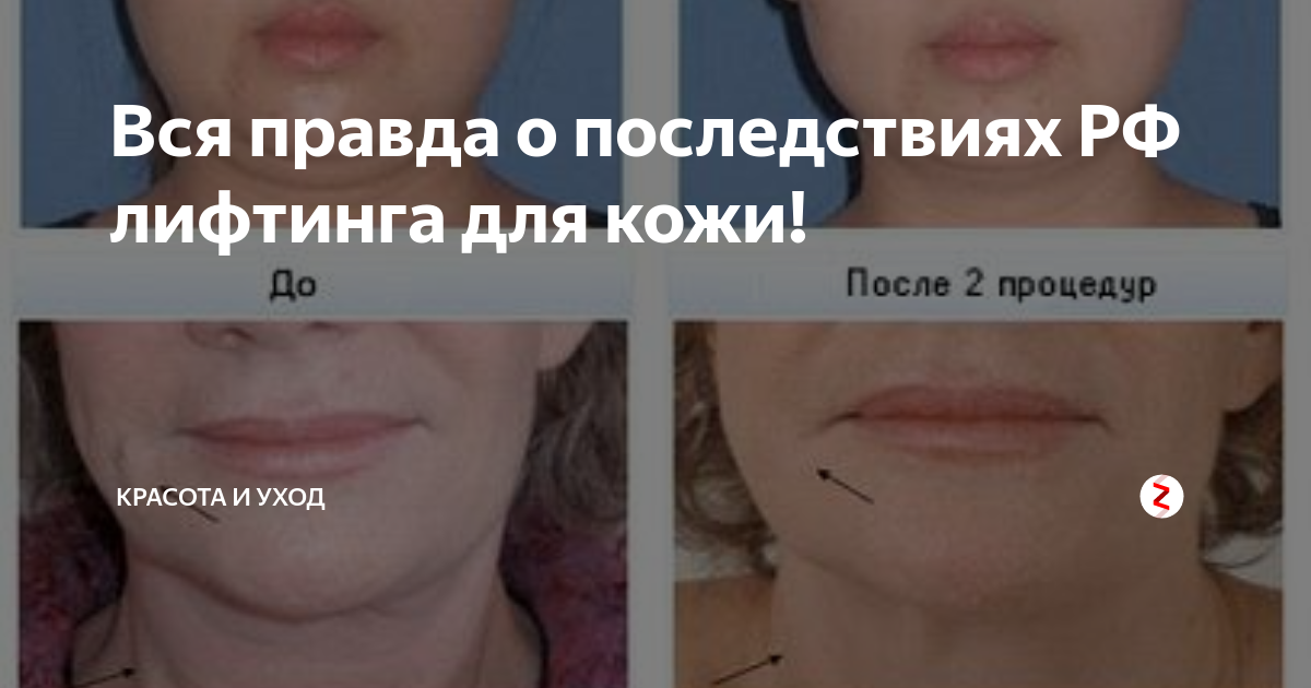 что дает рф лифтинг лица