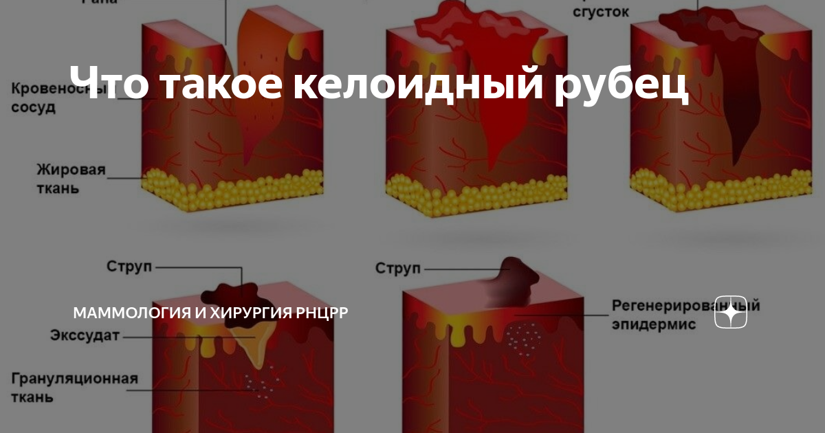 Что такое келоидный рубец | Маммология и хирургия РНЦРР | Дзен