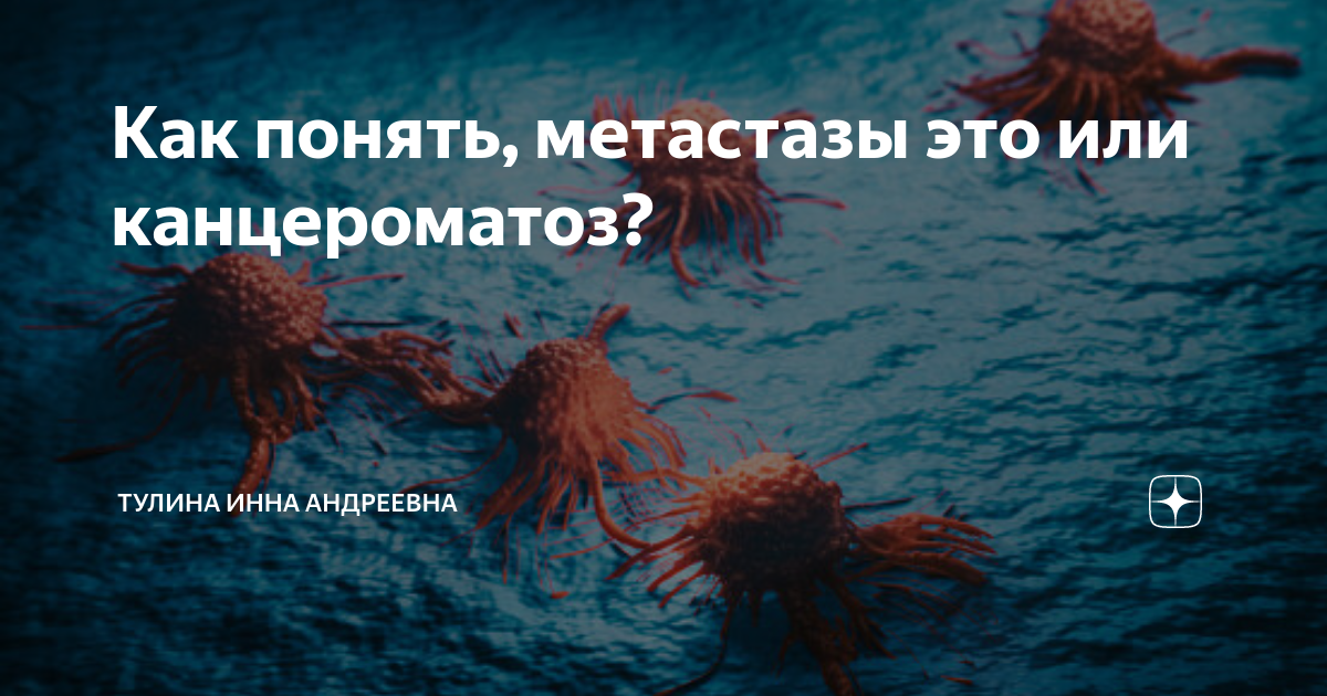 Как понять, метастазы это или канцероматоз? | Тулина Инна Андреевна | Дзен