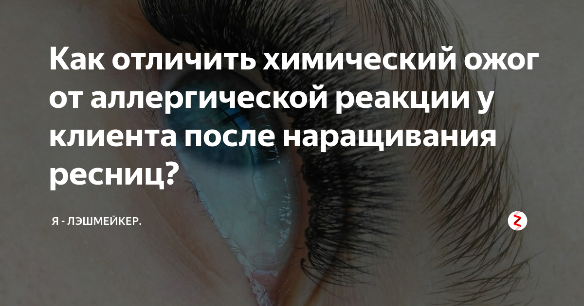 Ожог от ресницы капли. Аллергия на наращивание ресниц. Аллергия при наращивании ресниц. Реакция на нарощенные ресницы. Химический ожог после наращивания.