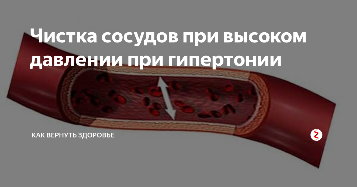 Очистка сосудов. Очистка кровеносных сосудов. Как почистить сосуды. Чистка артерий и сосудов. Чистка кровяных сосудов.