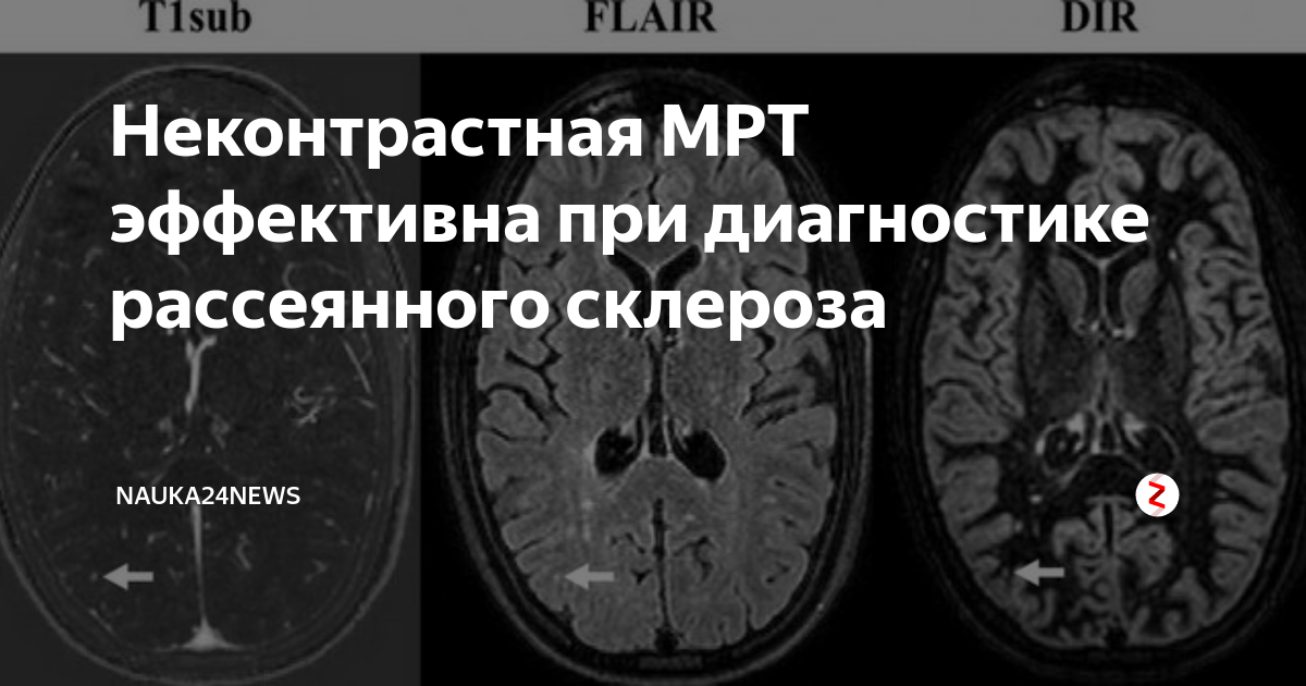 Мрт головного мозга без контраста что покажет