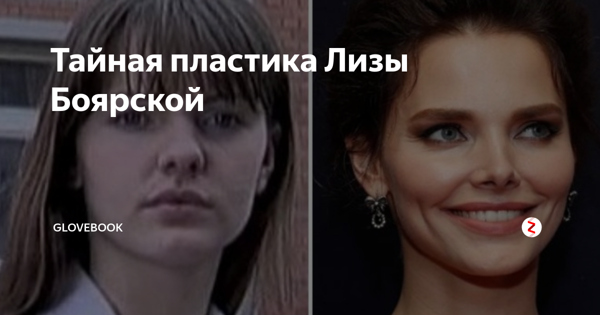 Разоблачены пластические операции Лизы Боярской (ФОТО до и после) - Аргументы Не