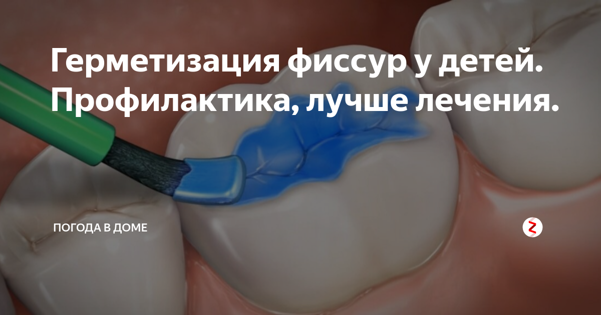 профилактика герметизация фиссур. герметизация фиссур детская. герметизация фиссур стоматолога. профилактика кариеса зубов у взрослых пациентов. профилактика герметизация фиссур.