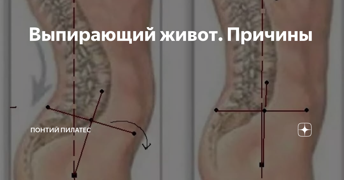 Рука выпирает из живота. Прогиб в пояснице и выпирающий живот. Почему кости торчат