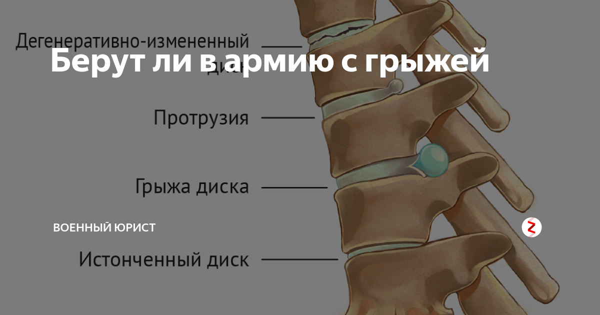 Что такое грыжа диска L5-S1, ее особенность?