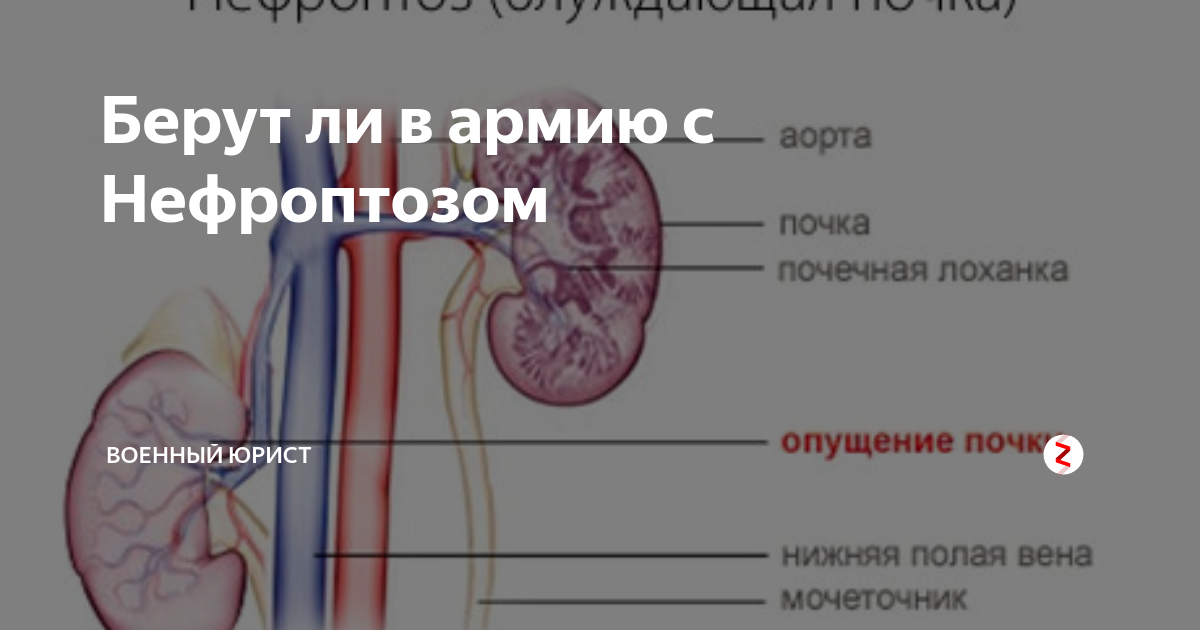 Нефроптоз берут ли в армию. С одной почкой берут в армию.