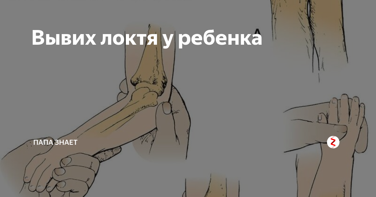 Вывих локтевого сустава у детей. Вывих локтевого сустава: лечение и восстановление, можно ли вправить. Привычный вывих плеча - лечение и операция в НМИЦ им. Г.И. Турнера Вывихи суставов. Полное описание: причины, симптомы, диагностика.