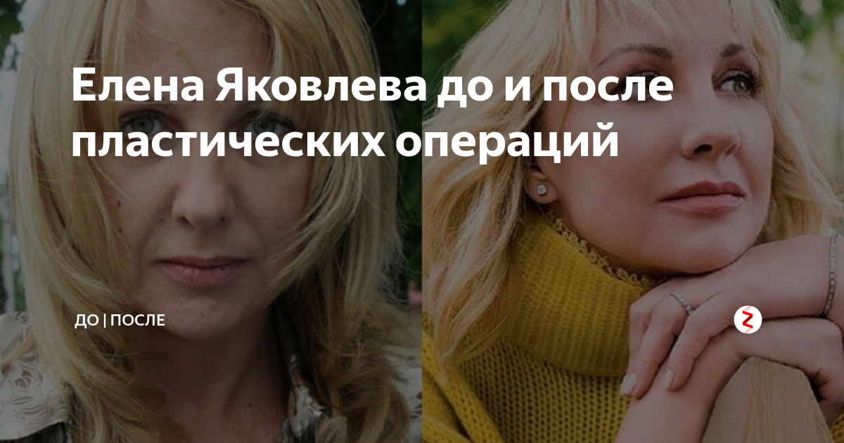 Елена Яковлева и другие знаменитости до и после того, как решили измениться