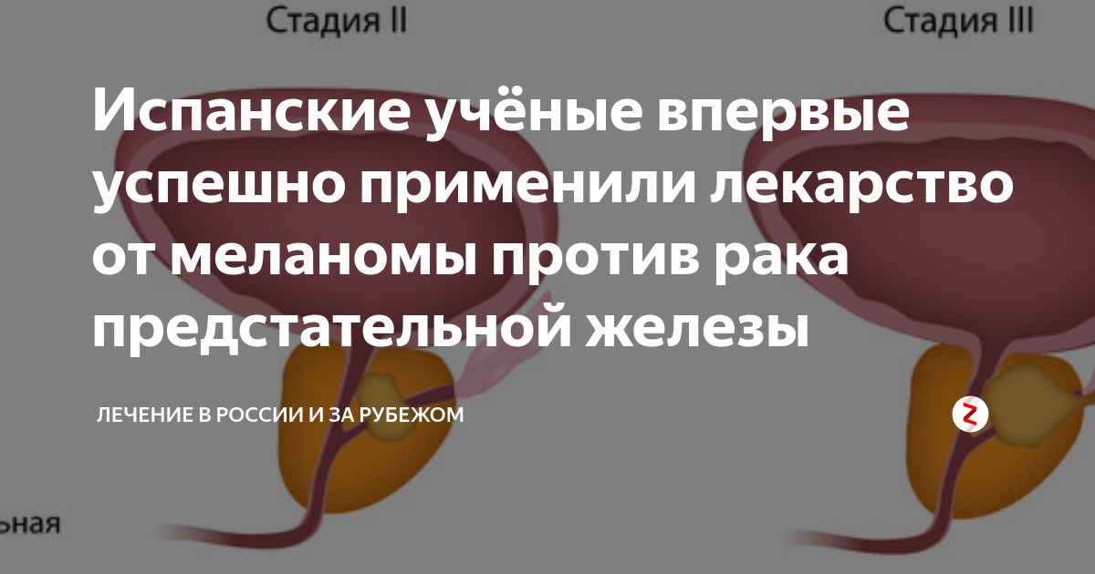 Удаление простаты последствия для мужского. Лекарство онкология предстательной железы. Опухоли простаты презентация. Таблетки от кисты простаты. Опухоль предстательной железы у мужчин причины.